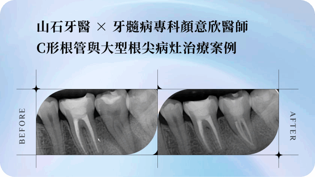 山石牙醫 × 牙髓病專科顏意欣醫師 C形根管與大型根尖病灶治療案例