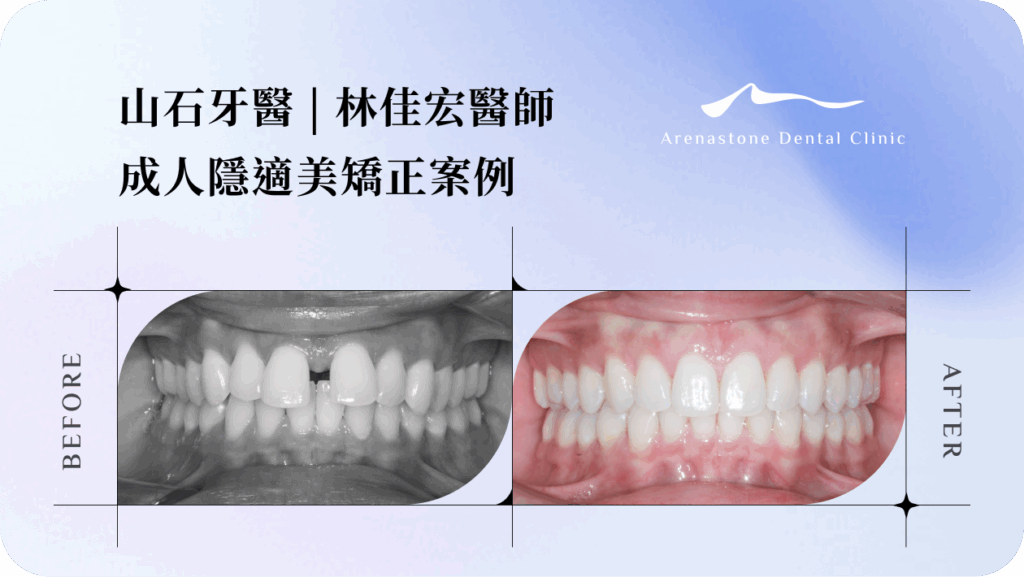 【從漏財門縫到微笑曲線】山石牙醫 林佳宏醫師｜成人隱適美矯正案例