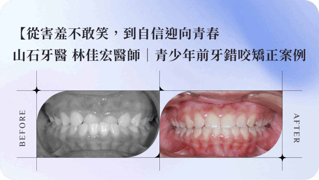 【從害羞不敢笑，到自信迎向青春】山石牙醫 林佳宏醫師｜青少年前牙錯咬矯正案例