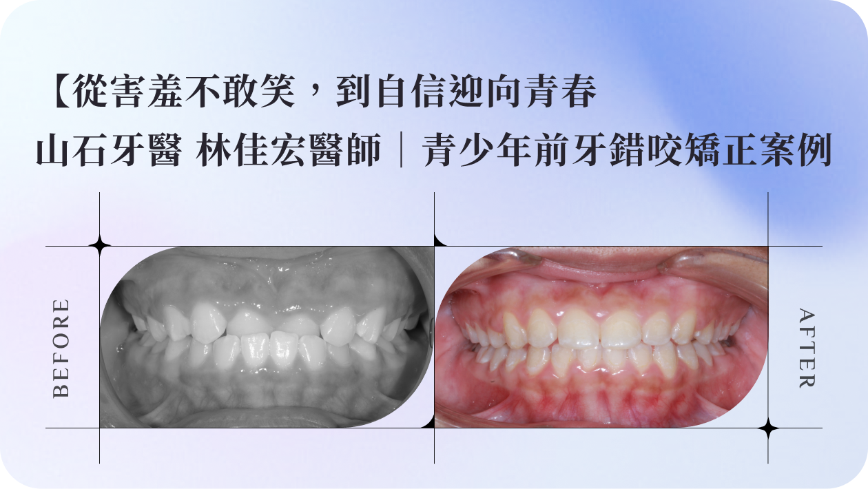 【從害羞不敢笑，到自信迎向青春】山石牙醫 林佳宏醫師｜青少年前牙錯咬矯正案例
