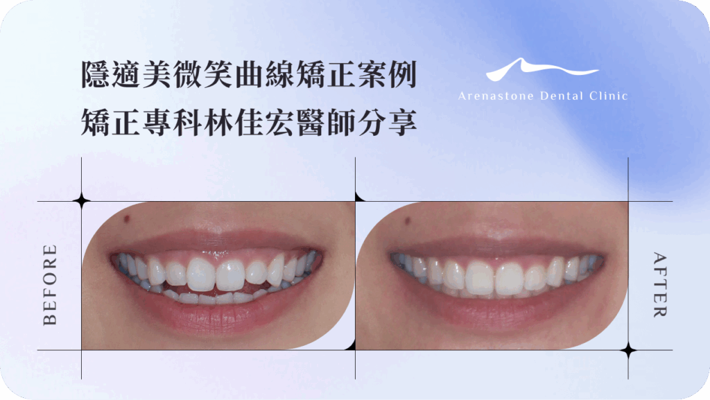 隱適美微笑曲線矯正案例｜矯正專科林佳宏醫師分享