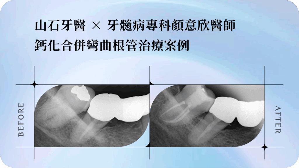 山石牙醫 × 牙髓病專科顏意欣醫師 鈣化合併彎曲根管治療案例