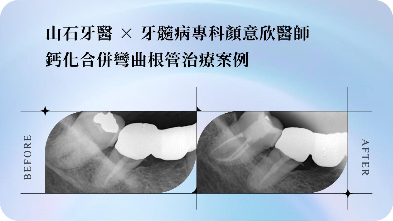 【顯微鏡下的溫柔堅定】牙髓病專科顏意欣醫師｜鈣化合併彎曲根管治療案例
