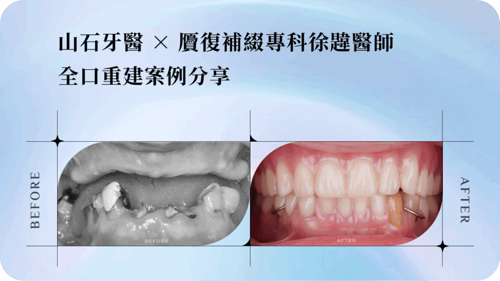 山石牙醫 × 贗復補綴專科徐韙醫師 全口重建案例分享