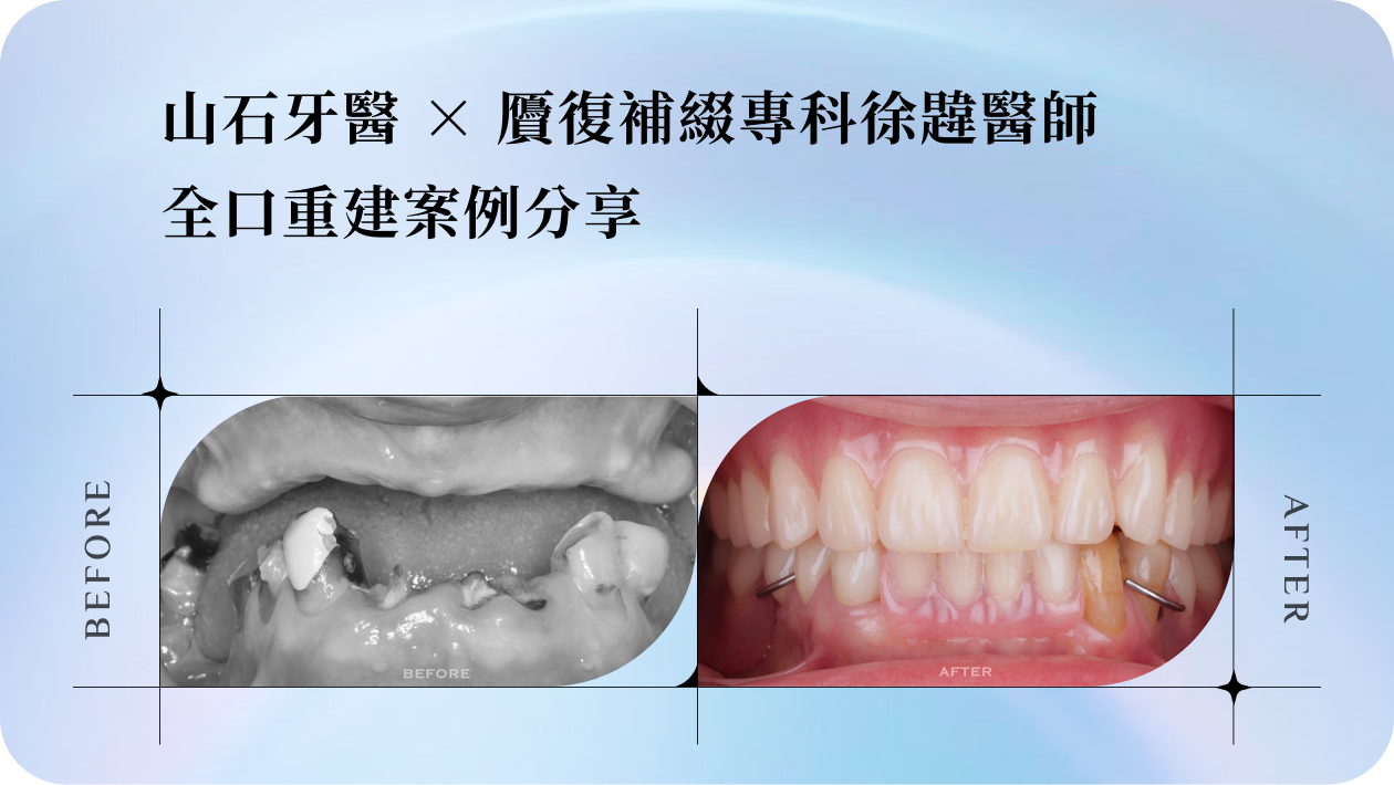 【重新咬下一口人生的滋味】山石牙醫 × 贗復補綴專科徐韙醫師｜全口重建案例分享
