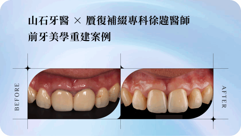 【重拾笑容的勇氣】 山石牙醫 × 贗復補綴專科徐韙醫師｜前牙美學重建案例