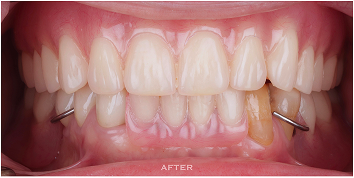 山石牙醫全口重建