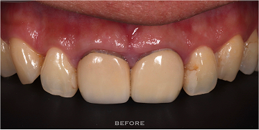 山石牙醫前牙全瓷仿生修復