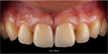 山石牙醫前牙全瓷仿生修復