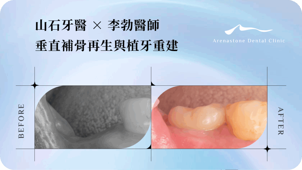 【牙周病後骨重建植牙案例】山石牙醫 ×李勃醫師｜ 垂直補骨再生與植牙重建