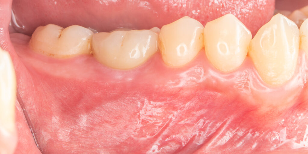 臼齒 蛀牙 植牙 重建