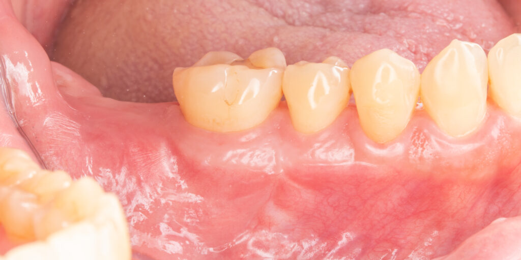 拔牙後軟硬組織缺損 - 山石牙醫|