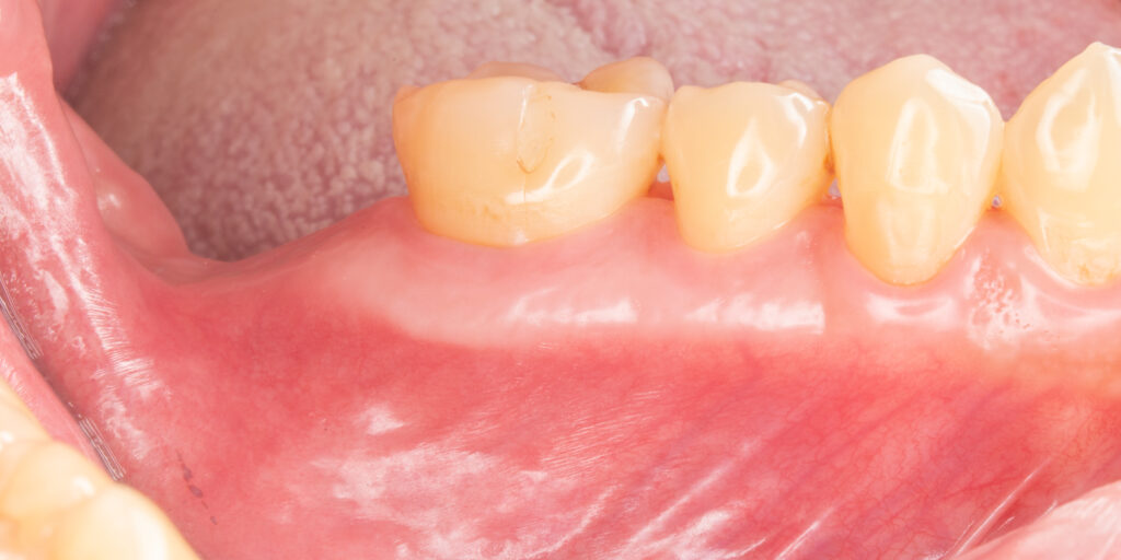 牙周病控制後可見垂直骨脊缺損