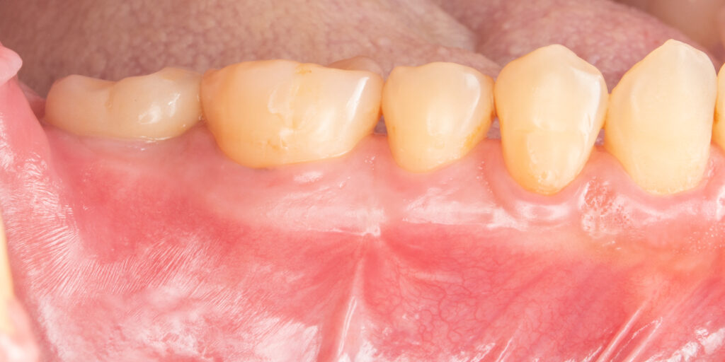 植牙重建咬合功能