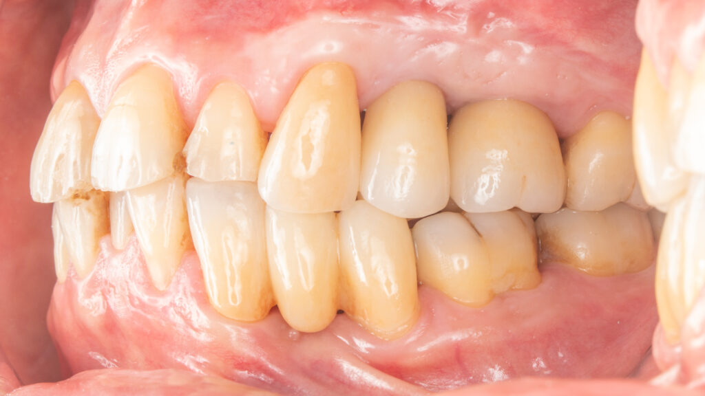 假牙裝戴重建咬合功能 山石牙醫