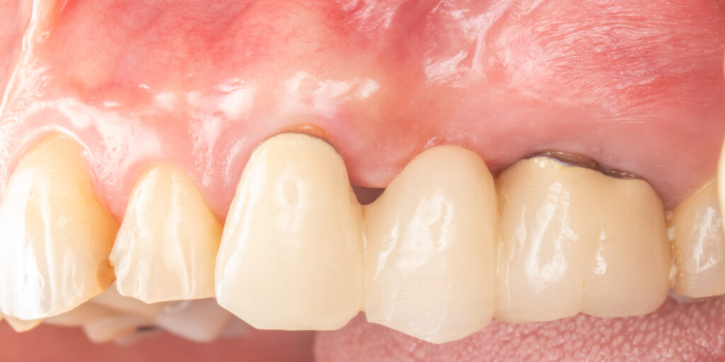 後牙功能重建 舊有鬆動牙橋